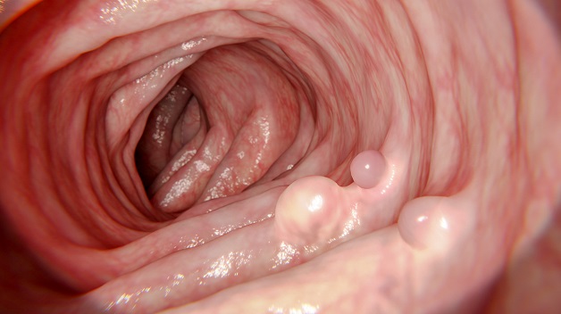 Polyp trực tràng là gì, cách phát hiện, điều trị và phòng tránh