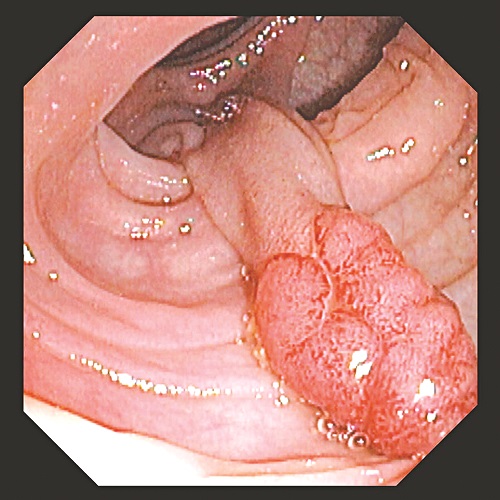 Polyp trực tràng ở người lớn