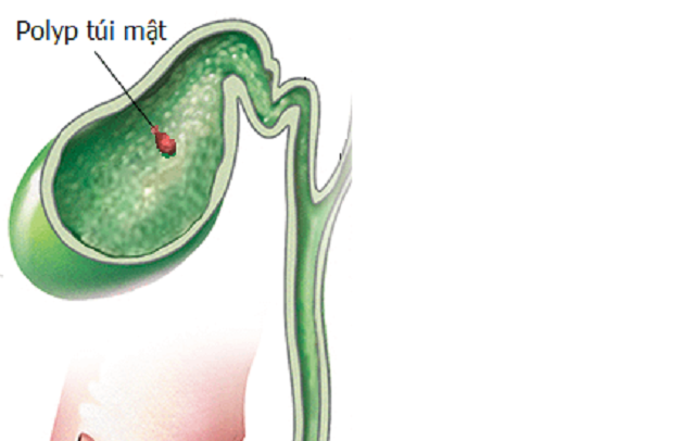 Polyp túi mật 3mm là gì? Điều trị thế nào để hiệu quả?