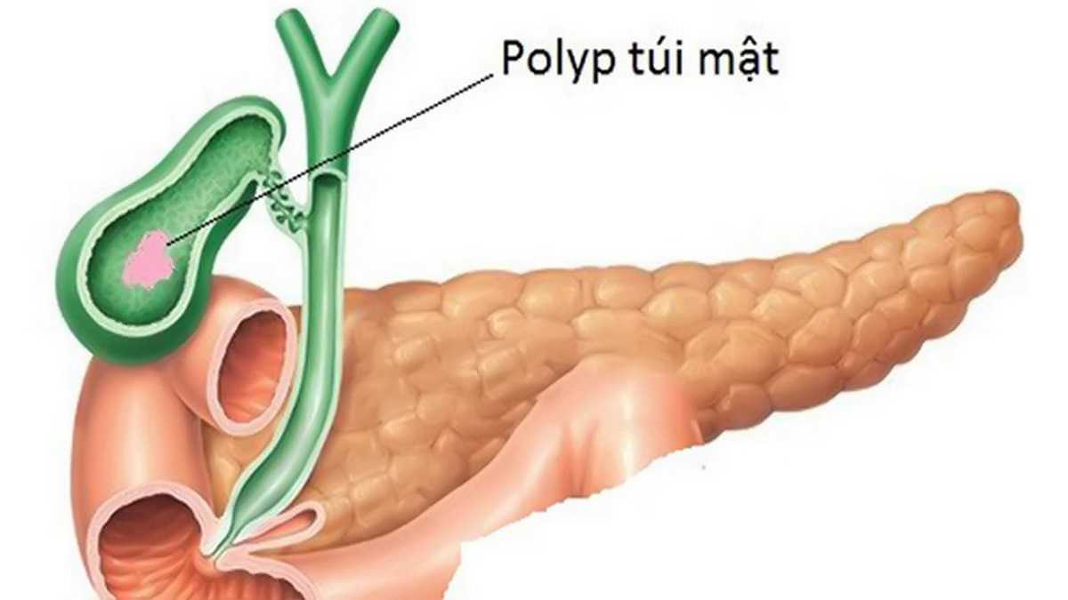  Polyp túi mật 5mm có nguy hiểm không? – Góc giải đáp