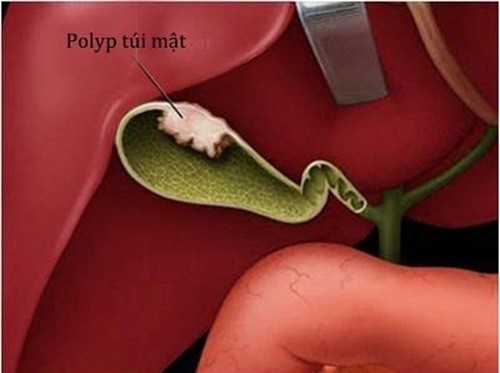 Polyp túi mật là gì và những vấn đề xung quanh