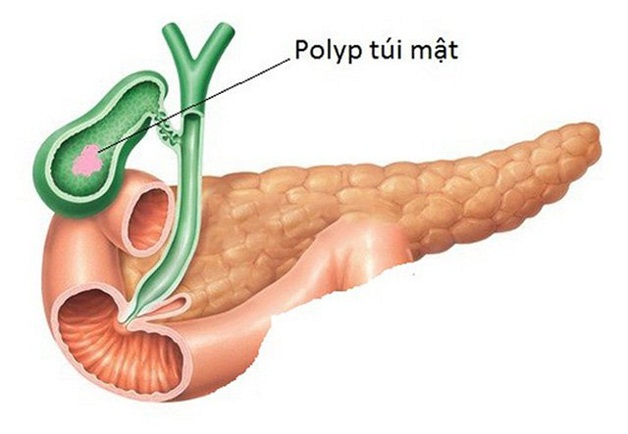 Polyp túi mật triệu chứng là gì và điều trị như thế nào?