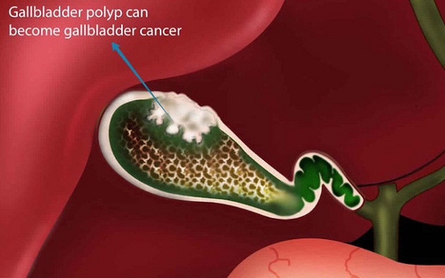 Polyp túi mật triệu chứng là gì và điều trị như thế nào?