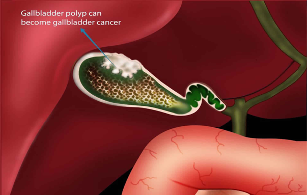 Polyp túi mật và nguy cơ ung thư hóa biểu mô túi mật