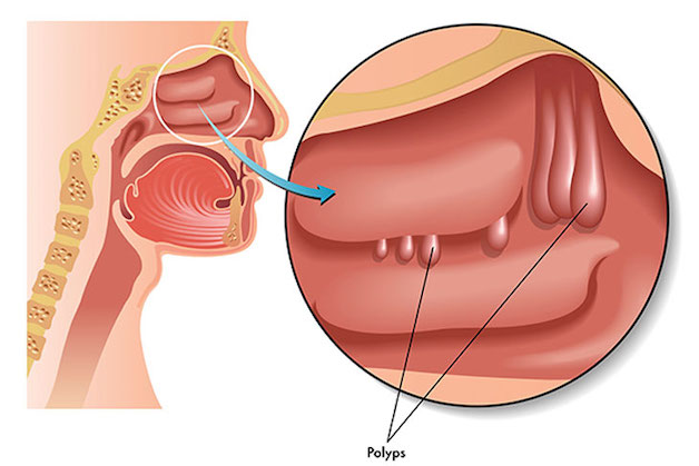 Polyp xoang mũi được chẩn đoán và điều trị như thế nào?