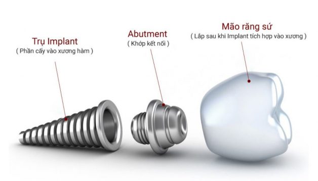 Quá trình cấy ghép implant chuẩn được như thế nào?