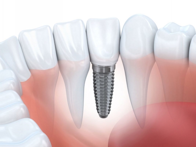 Quá trình cấy ghép implant và những ưu điểm