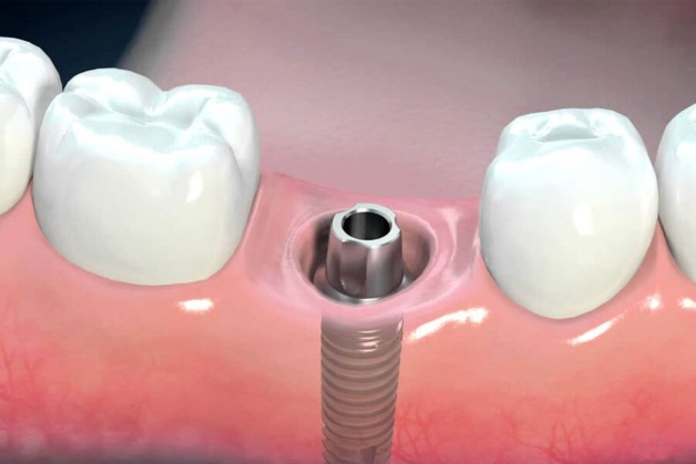 Quá trình cấy ghép implant và những ưu điểm