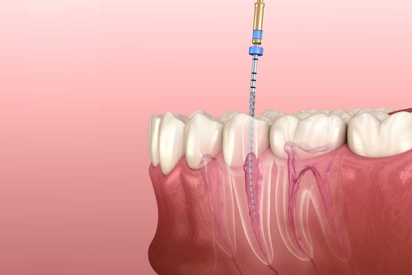 Quá trình điều trị tủy răng có lâu không?