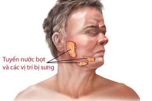 Quai bị dễ nhầm với viêm tuyến nước bọt