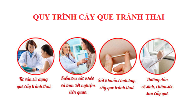 Quy trình cấy que tránh thai đúng cách thực hiện như nào?