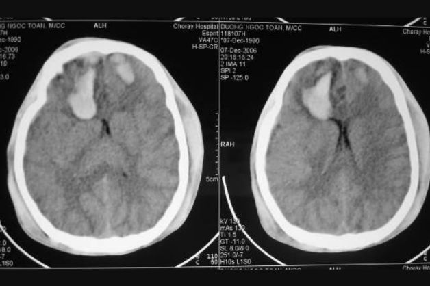 Quy trình chụp CT sọ não ra sao? Đọc kết quả như thế nào?