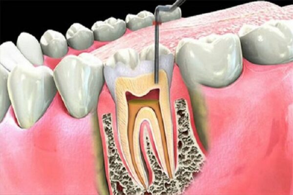 Quy trình điều trị tủy răng và những điều cần biết