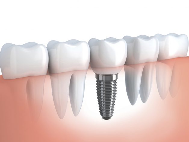 Quy trình ghép xương trong cấy ghép implant đúng chuẩn