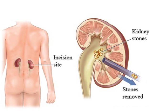 Quy trình mổ lấy sỏi thận qua da đường hầm nhỏ bằng laser