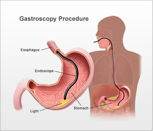 Quy trình nội soi dạ dày