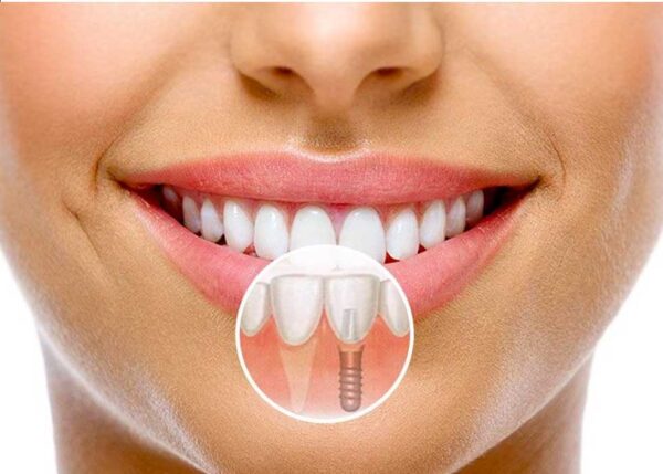 Quy trình trồng răng implant từ A đến Z