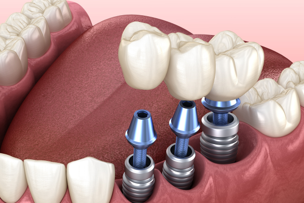 Quy trình trồng răng implant từ A đến Z