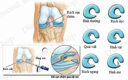 Rách sừng sau sụn chêm trong có nghiêm trọng?