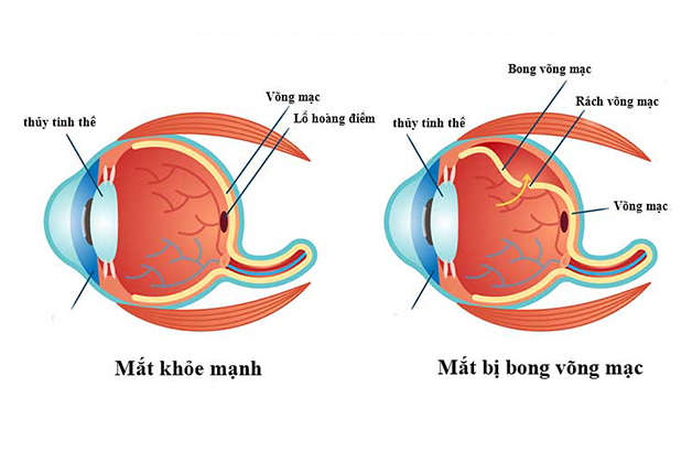 Rách võng mạc có nguy hiểm không?