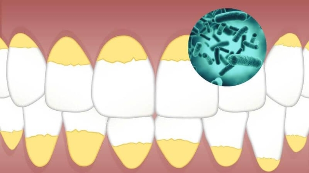 Răng bị vôi đóng nhiều và những ảnh hưởng