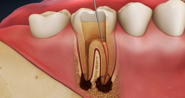 Răng cấm lung lay có nên nhổ không, bạn có biết?