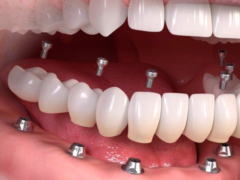 Răng cấy ghép implant: Thời gian thực hiện và chi phí