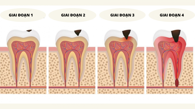 Răng hàm bị sâu và hậu quả không ngờ đối với sức khỏe