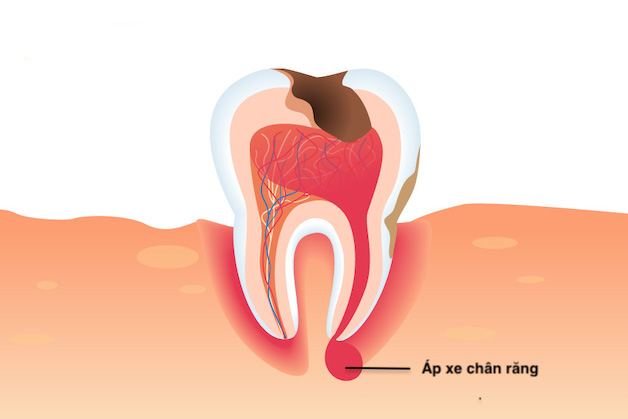 Răng khôn bị viêm tủy nguy hiểm như thế nào?