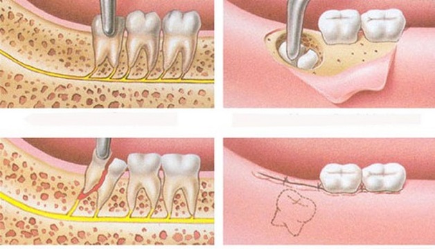 Răng khôn mọc ngầm trong xương: tác hại và cách chữa trị 