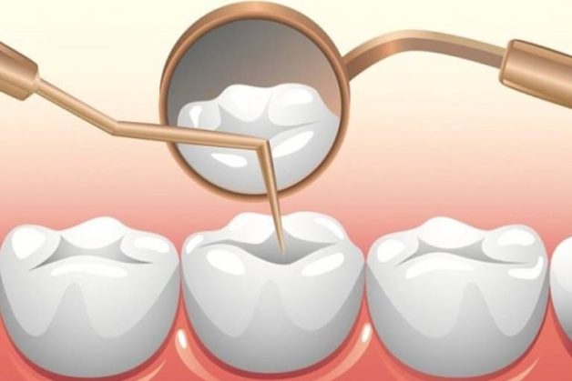 Răng sâu bị vỡ có thể dẫn đến mất răng vĩnh viễn không?