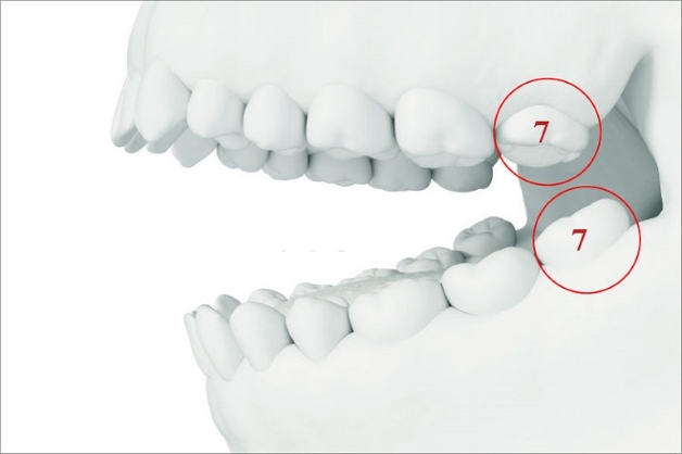 Răng số 7 mọc khi nào và hậu quả khi gãy rụng