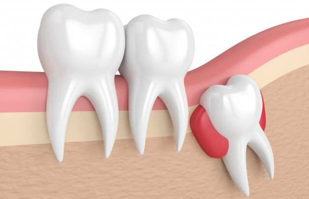 Răng số 8 là ở đâu? Có cần thiết phải nhổ không?