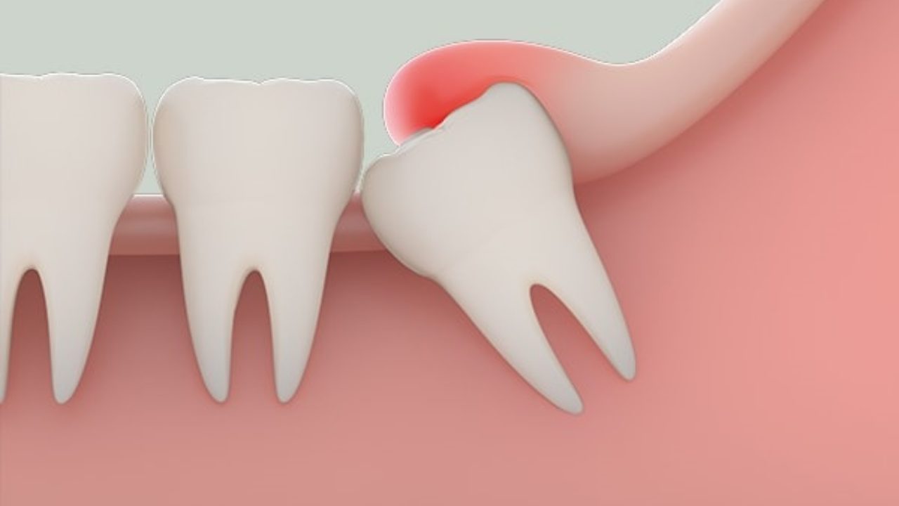 Răng số 8 mọc lệch có nên nhổ không, bạn có biết?