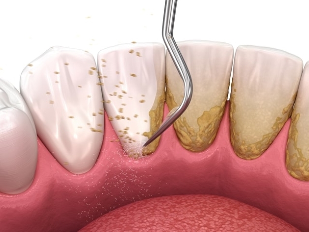 Răng sứ có phải cạo vôi răng không và nguyên nhân