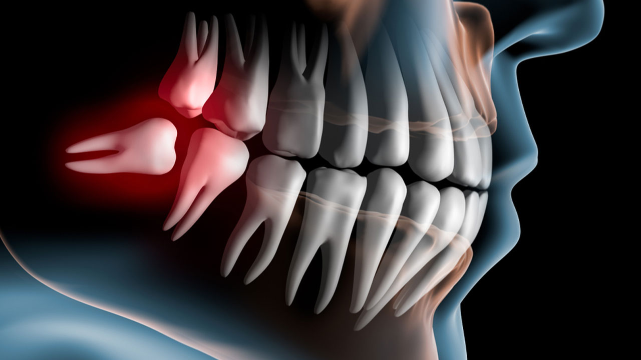 Răng trong cùng hàm dưới bị sâu – Nguyên nhân và Điều trị