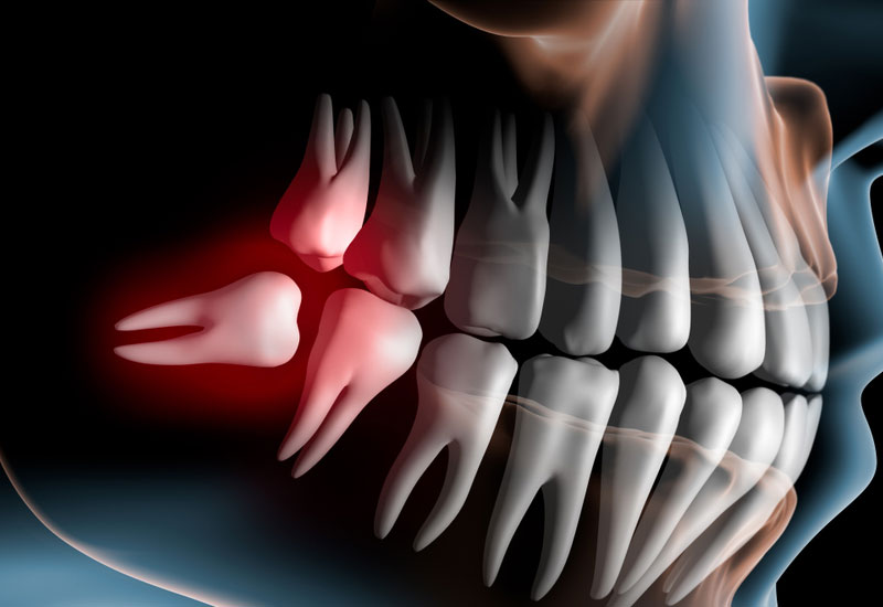 Răng trong cùng hàm dưới bị sâu – Nguyên nhân và Điều trị