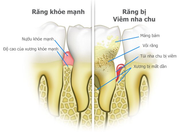 Răng tự nhiên lung lay: Làm gì cho răng chắc khỏe?