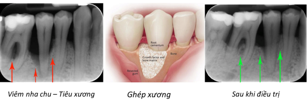 Răng tự nhiên lung lay: Làm gì cho răng chắc khỏe?