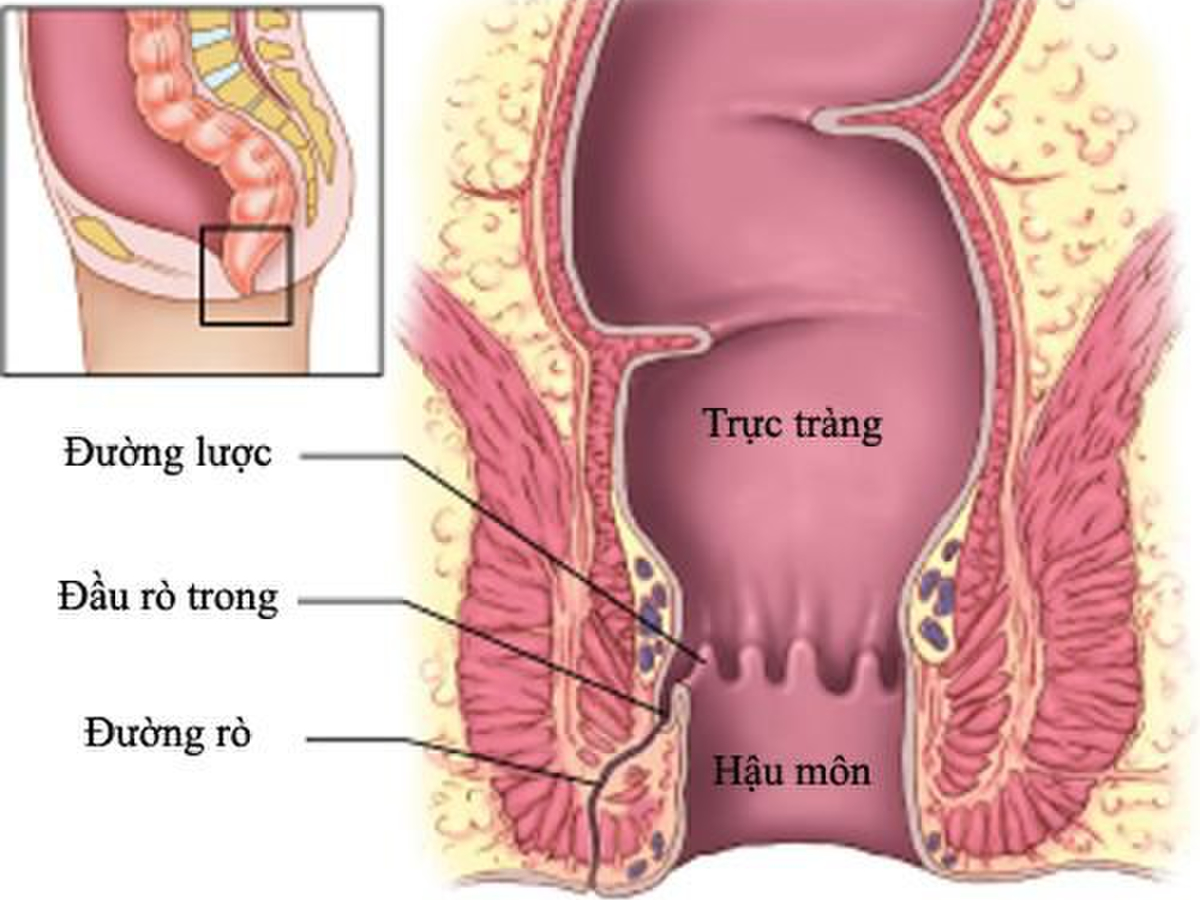 Rò hậu môn là thế nào? – Góc giải đáp