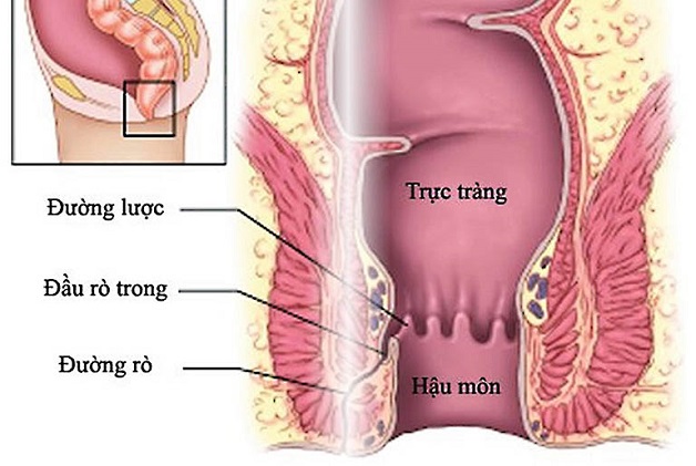 Rò hậu môn mri là gì? – Những thông tin cần biết