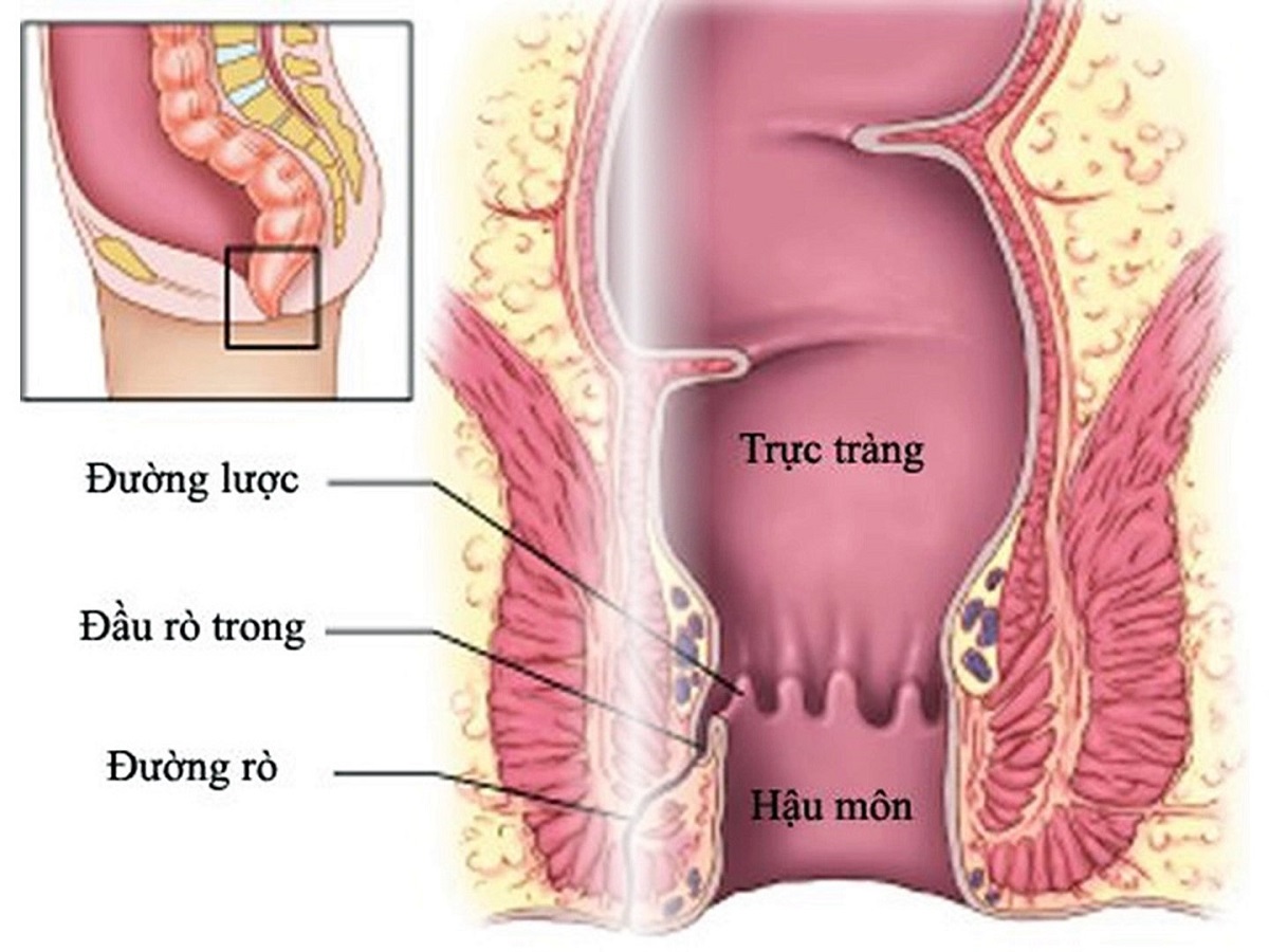 Rò hậu môn – Những điều bạn cần biết