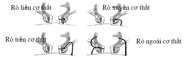 Rò hậu môn: Phân loại, nguyên nhân, biểu hiện lâm sàng và điều trị