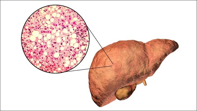 Rối loạn gan nhiễm mỡ: Những đối tượng dễ mắc