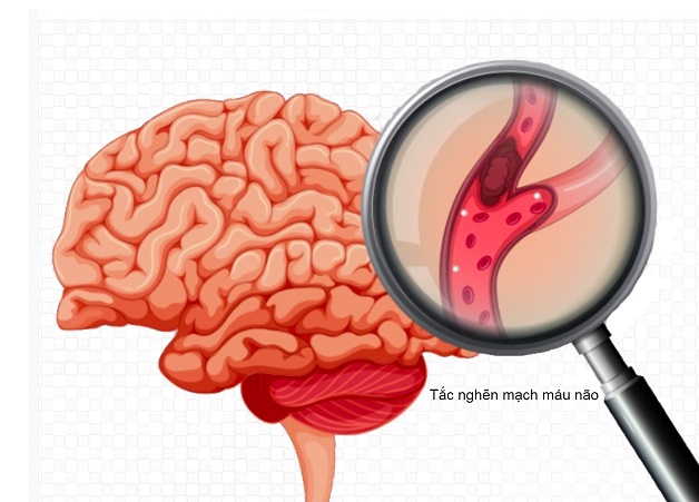 Rối loạn giấc ngủ kéo theo nhiều bệnh nguy hiểm