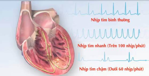 Rối loạn nhịp tim: các yếu tố nguy cơ