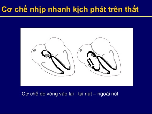 Rối loạn nhịp tim nhanh có những loại nào?