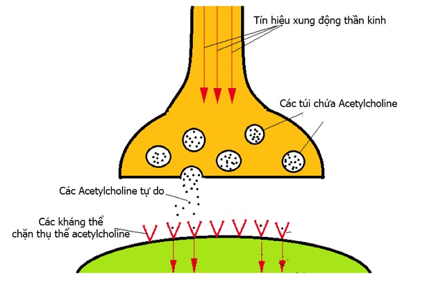 Rối loạn thần kinh cơ dễ biến chứng suy hô hấp