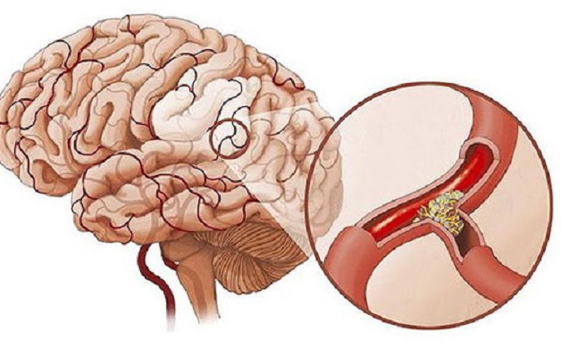 Rối loạn tiền đình trung ương dai dẳng, khó chữa