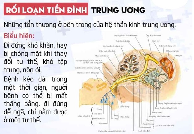 Rối loạn tiền đình và dấu hiệu nhận biết